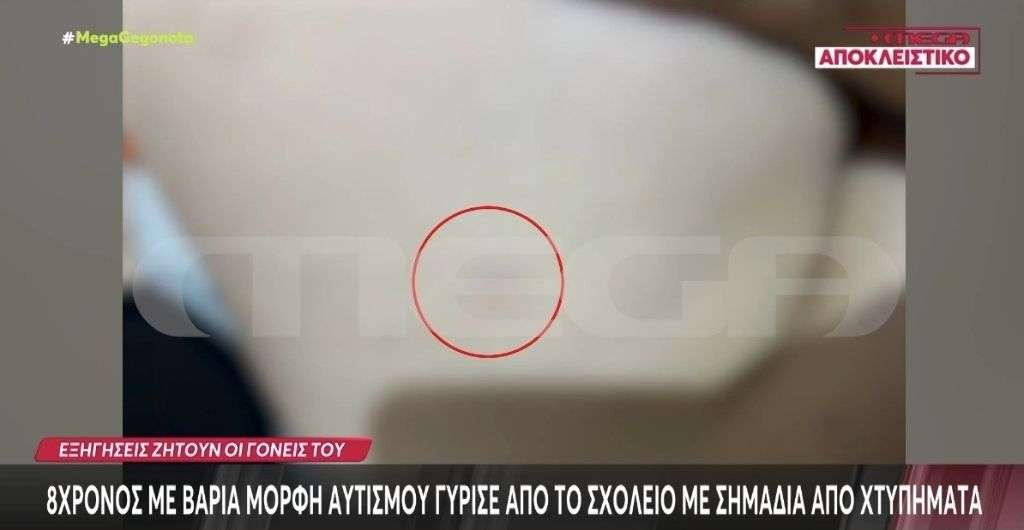 Πρέβεζα: 8χρονος με βαριά μορφή αυτισμού γύρισε από το σχολείο με σημάδια από χτυπήματα – Τι έδειξε η ιατροδικαστική